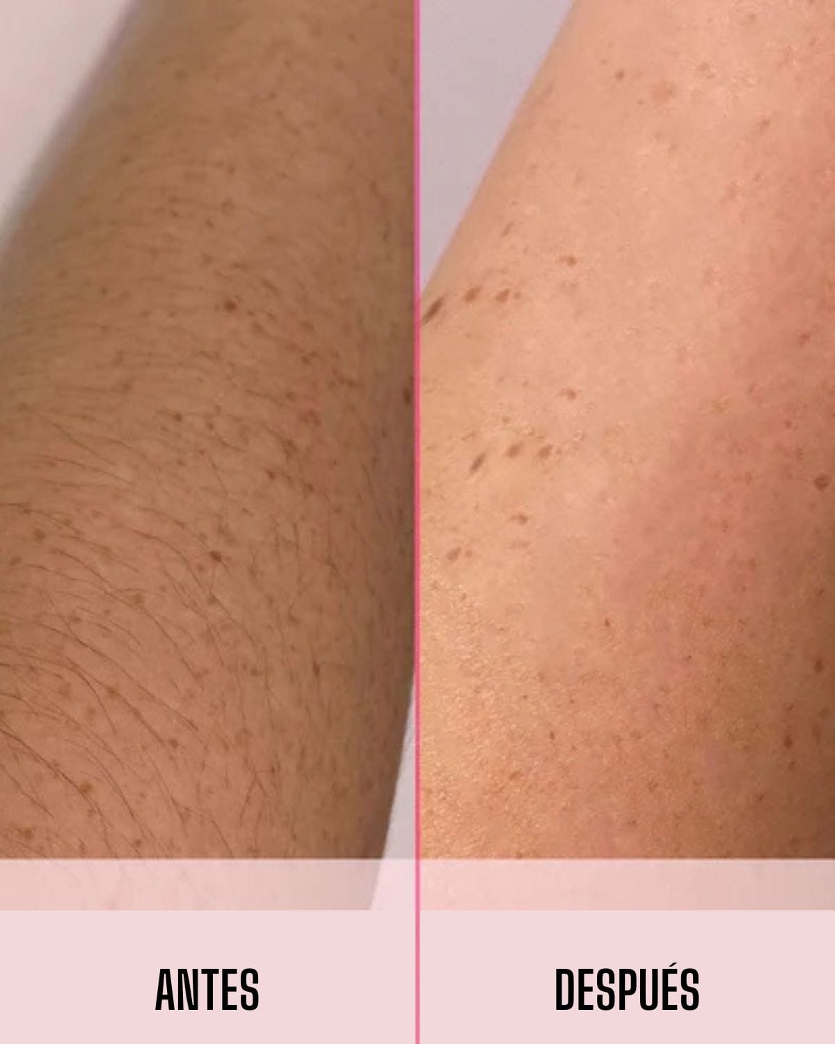 Mibodi ™ Depiladora  Laser IPL