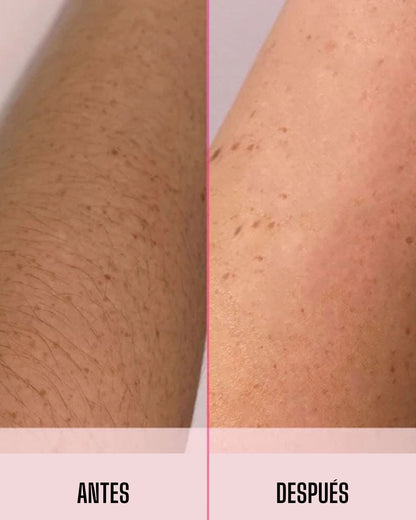 Mibodi ™ Depiladora  Laser IPL